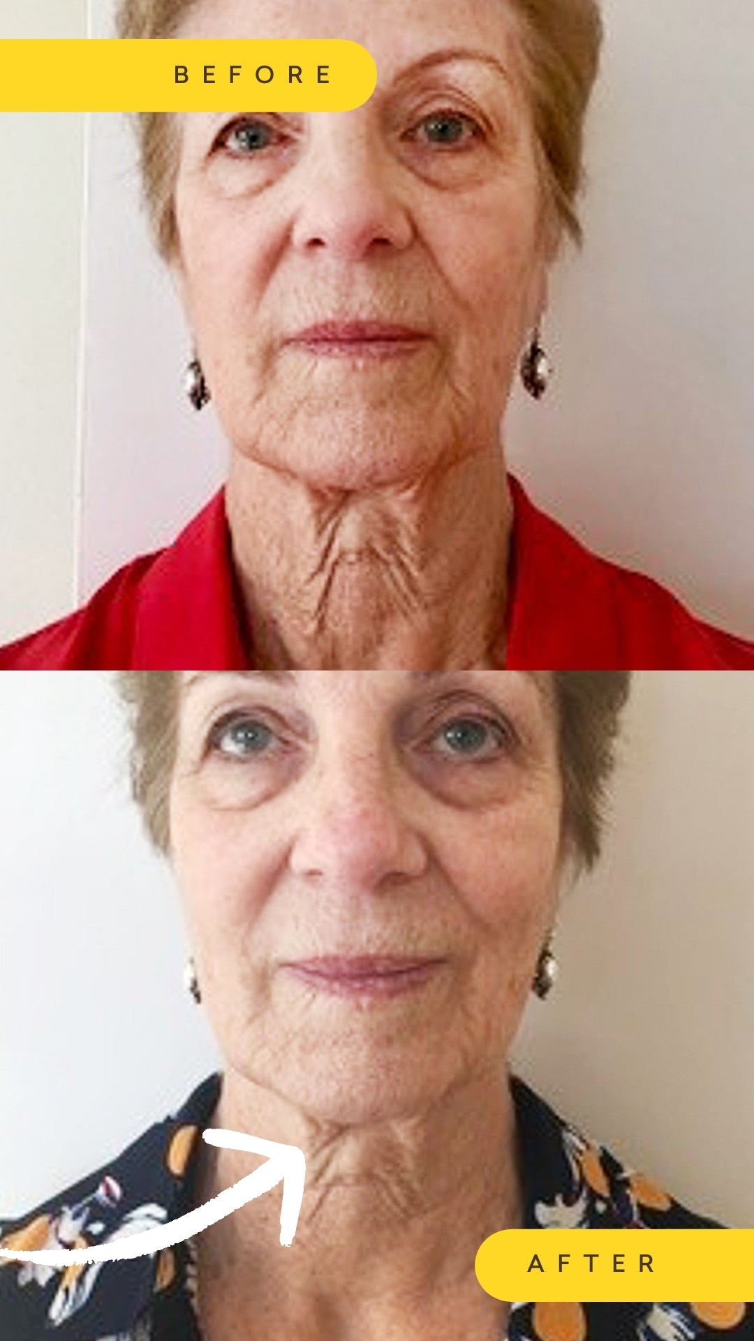 Before and after comparison photo of a person's neck with a cosmetic difference.